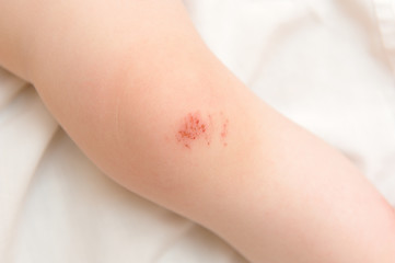 The child injured the knee during the fall and now the scratch
