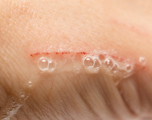 Fototapeta premium a scratch on the arm