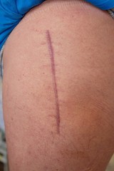 One year old scar following surgery of hip joint. Replacing of the devastated hip joint for the hip endoprosthesis