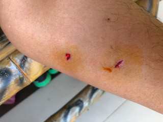 Dog bite wounds on calf leg