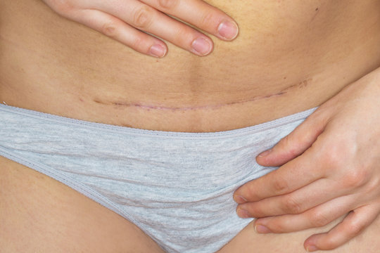 Closeup of a scar on the belly of a woman who had a caesarean operation