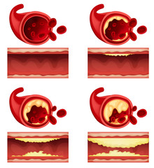 Diagram showing blood clot