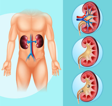 Human and kidney stones