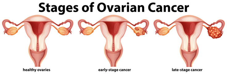 Diagram showing stages of ovarian cancer - obrazy, fototapety, plakaty