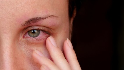Sick red human eye of a young woman. A girl takes off her glasses, showing a red eye. Tired eyes...