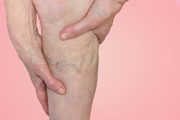 Fototapeta premium The varicose veins on a legs of old woman on blue