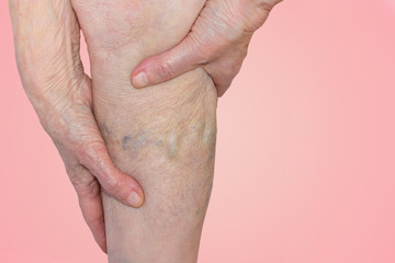 The varicose veins on a legs of old woman on blue