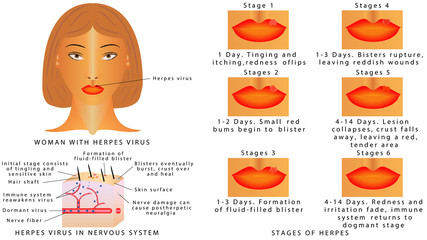 Herpes on lips