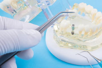 implant and orthodontic model for student to learning teaching model showing teeth.