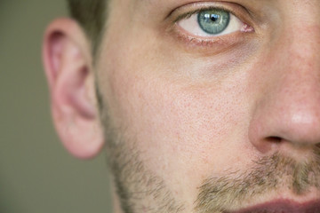 Obraz premium acne on the face. pores on the face