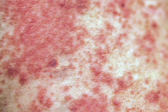 Allergic rash on the body close