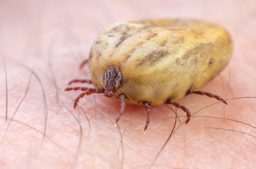Tick filled with blood sitting on human skin