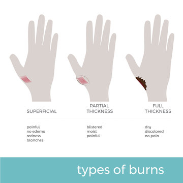 vector illustration of types of burns showed on hand