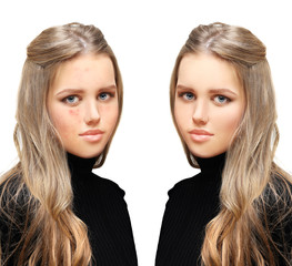 Post-Acne Marks /Treating Acne Scars