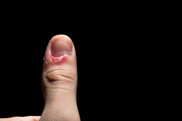 Left thumb with bruised wounds on a black background