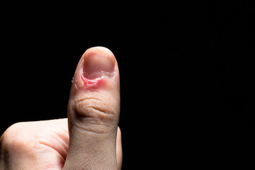 Left thumb with bruised wounds on a black background