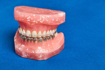 Human jaw or teeth model with metal wired dental braces