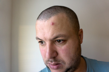 Fototapeta premium pimple or acne abcess closeup .