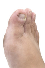 Close up of Fungus Infection on Nails foot, Finger with onychomycosis.