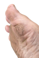 foot ,Heel break , care ,selective focus of cracked heels.