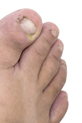 Close up of Fungus Infection on Nails foot, Selective focus of finger with onychomycosis.