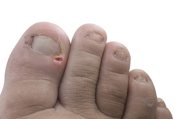 Close up figure out the nail, Accident nail trauma,bleeding toe nails.