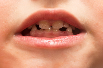 child's mouth without teeth