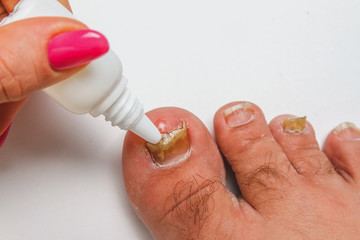 A toenail fungus