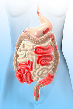 Crohn's disease, a type of inflammatory bowel disease, medically illustration