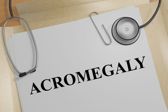 ACROMEGALY - medical concept