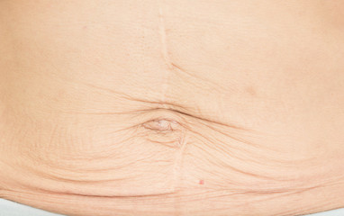  wrinkles Skin from pregnancy - obrazy, fototapety, plakaty