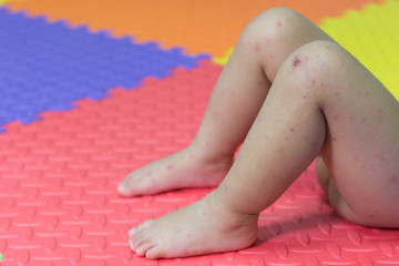 Hand foot and mouth disease.