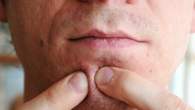 Skin irritation after shaving. Man's hands squeeze pimples on the chin. Closeup chin, lips and nose.