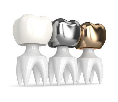 3d render of teeth with different types of dental crown