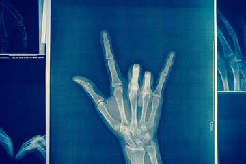 x-ray image of a hand making I love you symbols.