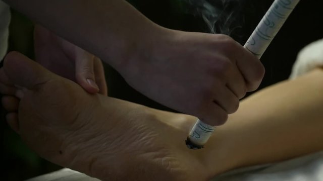 Traditional chinese medicine acupuncture process. Chinese traditional treatment, point heating of the body