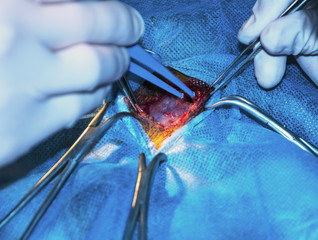 Electrosurgery. Stop the bleeding.  (vessels, blood, concept surgery)