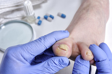 Onychomycosis, nail disease due to the action of pathogenic fungi.