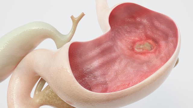 Stomach ulcer - high degree of detail - 3D Rendering