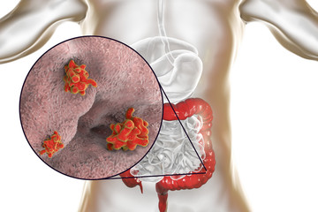 Entamoeba histolytica protozoan infection of large intestine. Parasite which causes amoebic dysentery and ulcers. 3D illustration