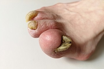 Fungus infection on nails of man's foot