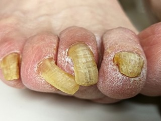 Fungus infection on nails of man's foot