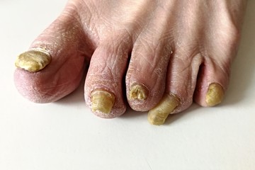 Fungus infection on nails of man's foot