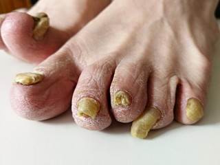 Fungus infection on nails of man's foot