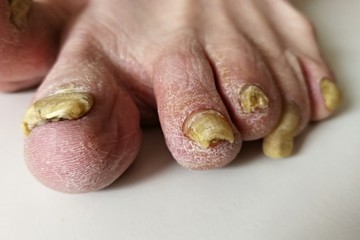 Fungus infection on nails of man's foot