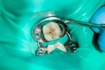 close-up of a human rotten carious tooth at the treatment stage in a dental clinic