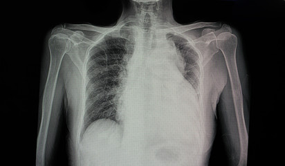 chest x-ray film  of a patient with cardiomegaly