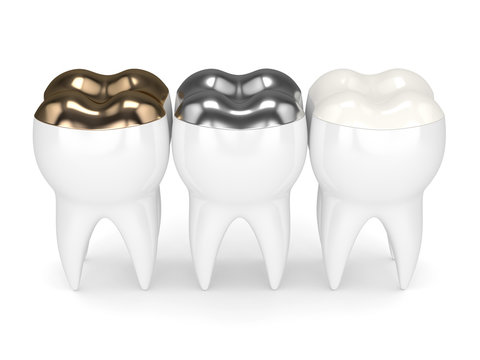 3d render of teeth with different types of dental filling