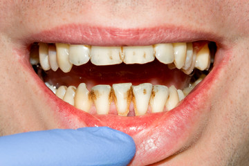 caries spoiled tooth closeup photographed
