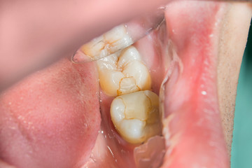 caries spoiled tooth closeup photographed